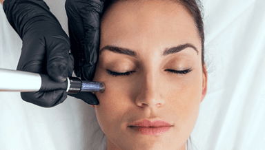 Image for Plant Based Stem Cell Microneedling/ Nanoneedling