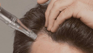 Image for PRP Microneedling Hair Restoration